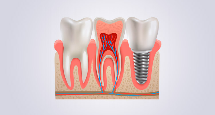 Colocación de implantes dentales paso a paso