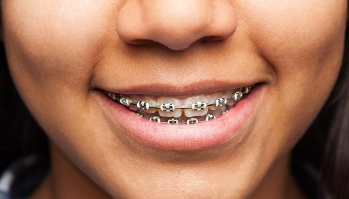 Todo lo que debes saber sobre cementos dentales (I): Introducción -  Dentaltix