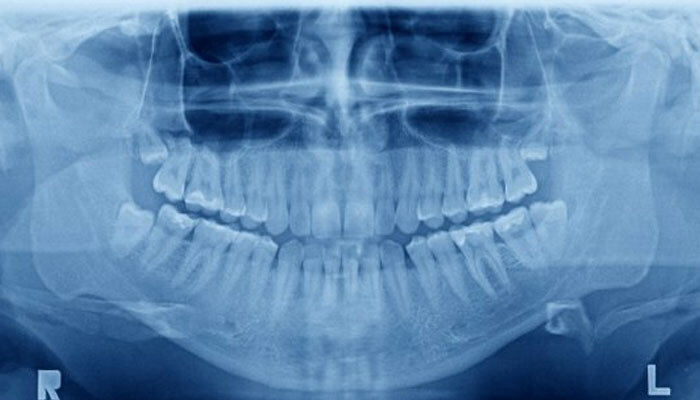 Pantomografía dental