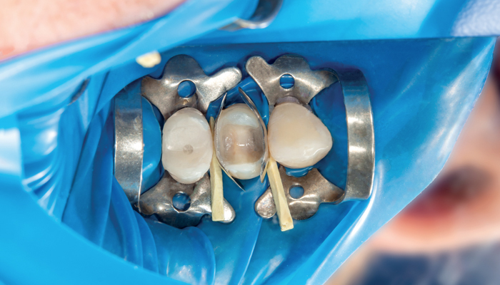 Dique de goma dental: qué es, usos y aplicaciones
