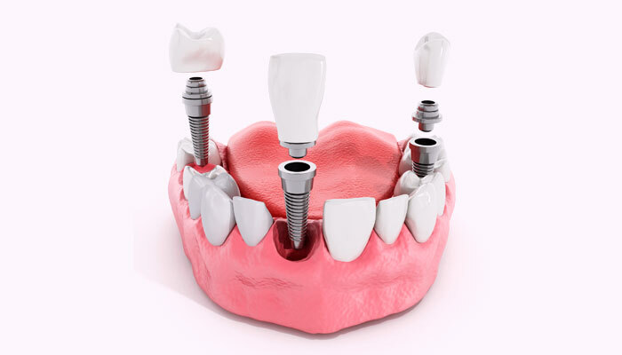 Implantes de zirconio: toda una novedad dental
