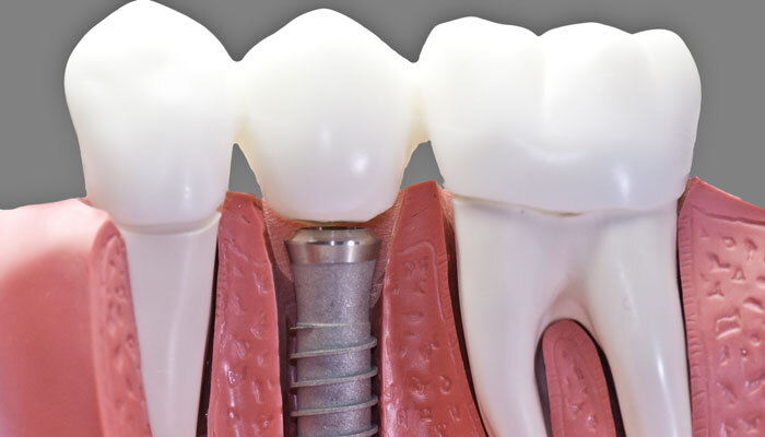 Conoce los diferentes tipos de implantes dentales sin tornillos