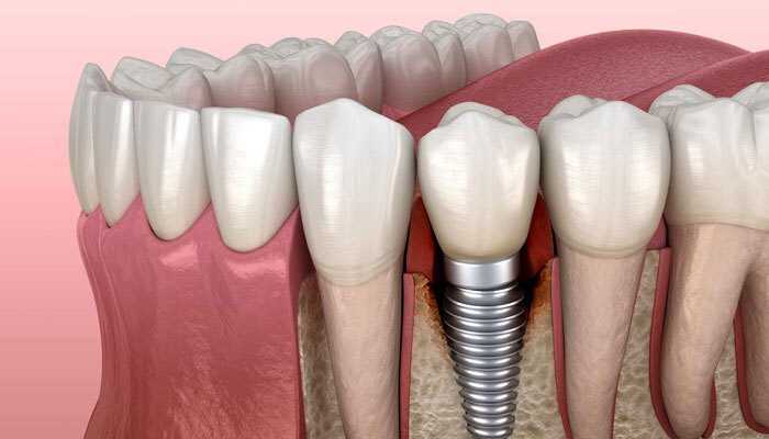 ¿En qué consiste la periimplantitis y cómo se debe tratar?