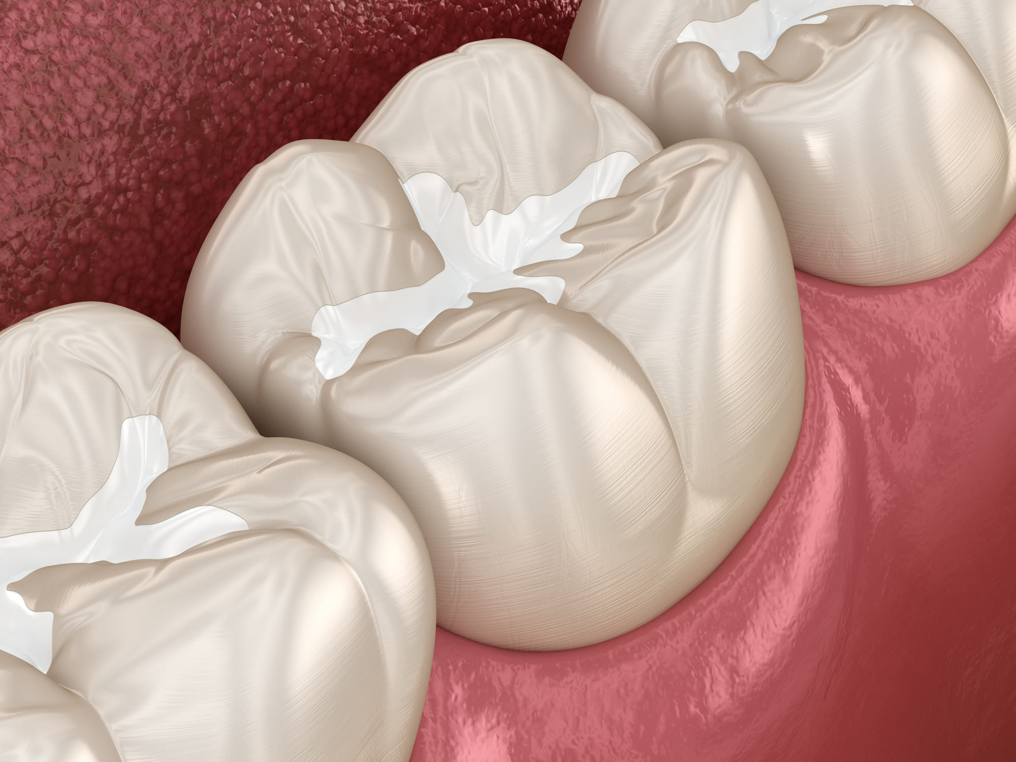 Selladores dentales para consulta dental