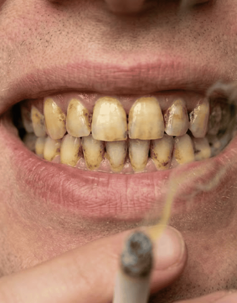 Dientes de fumador: mancha, tabaco y efectos en la boca