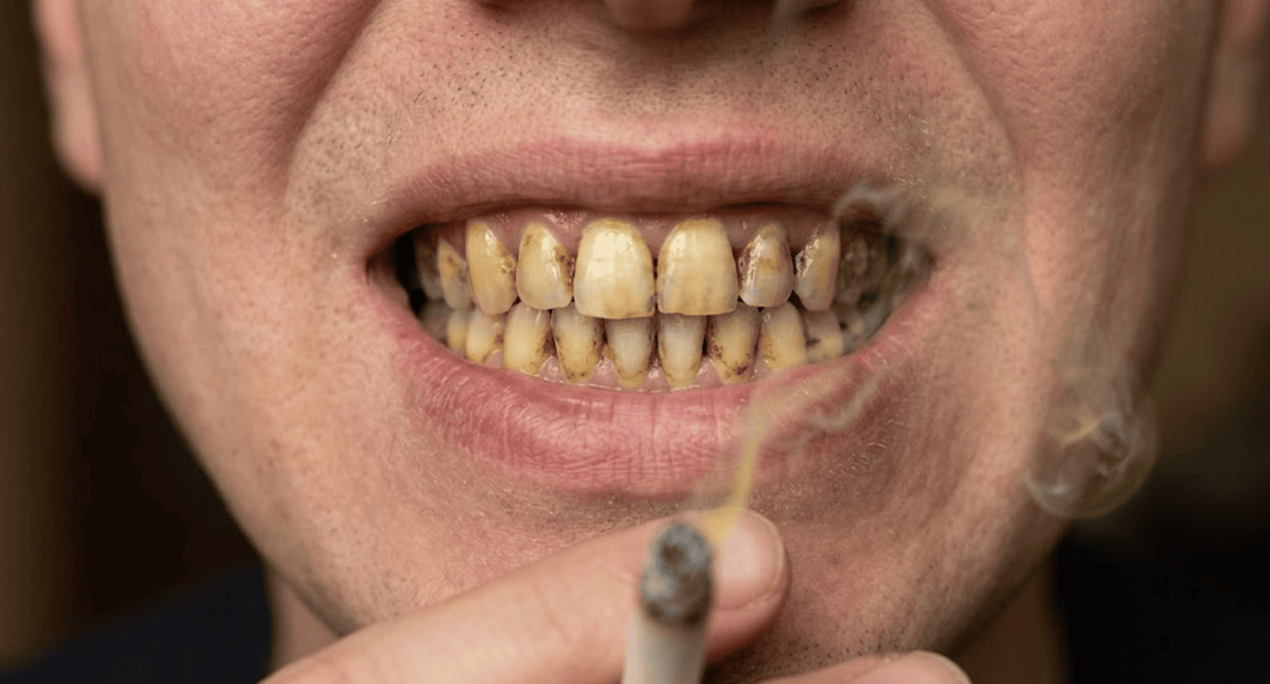 Dientes de fumador: mancha, tabaco y efectos en la boca