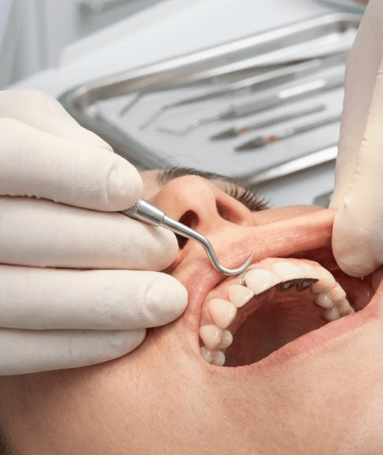Cómo quitar un puente dental cementado: paso a paso