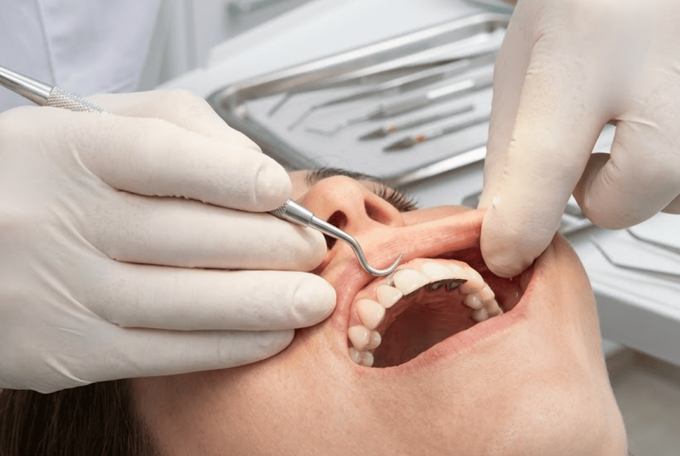 Cómo quitar un puente dental cementado: paso a paso